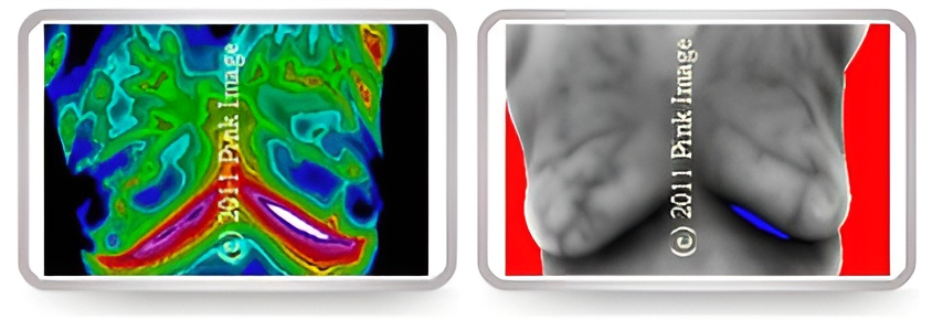 ABNORMAL THERMOGRAM 1