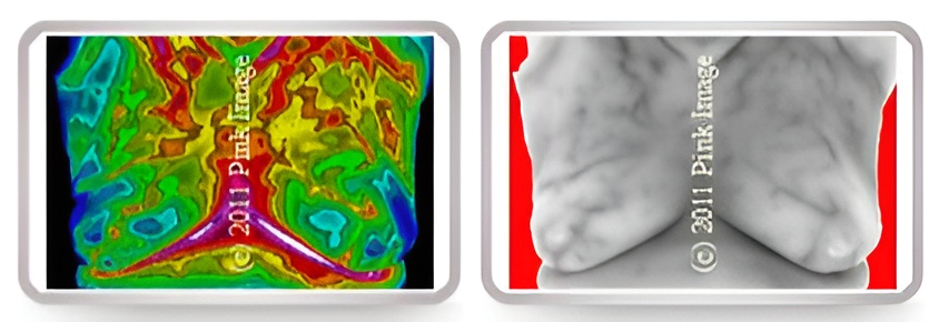 ABNORMAL THERMOGRAM 2
