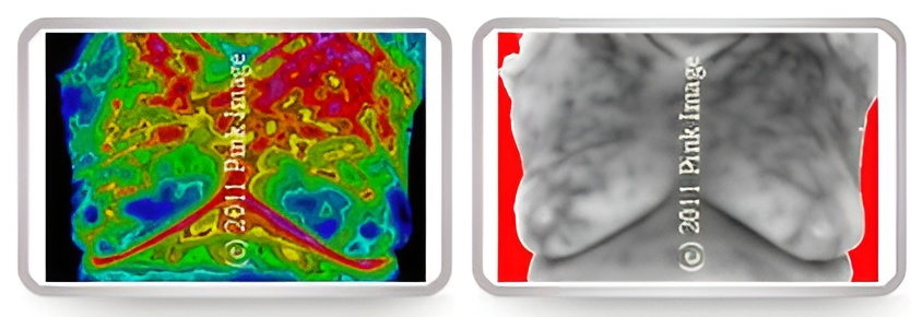 ABNORMAL THERMOGRAM 3